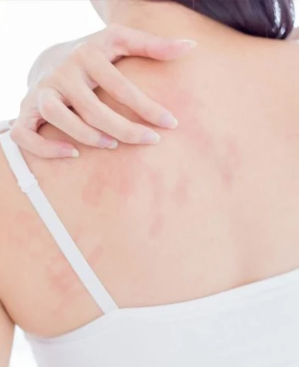 Eczema