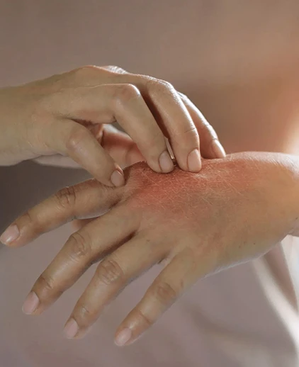 Fungal Infections